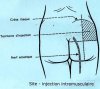 steroide-anabolisant.com-injection-intramusculaire.jpg