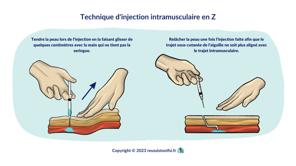 infographie-Technique-dinjection-intramusculaire-en-Z-1024x576.png