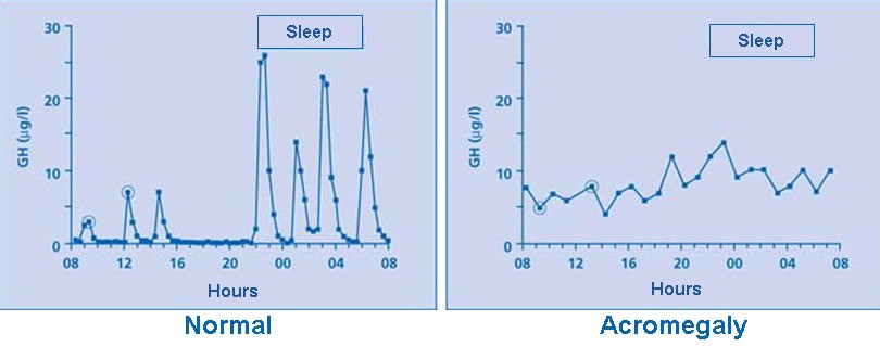 Acromegaly_growth_hormone_levels.JPEG