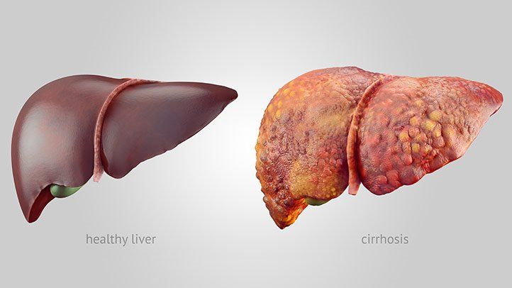 cirrhosis-of-the-liver-722x406.jpg